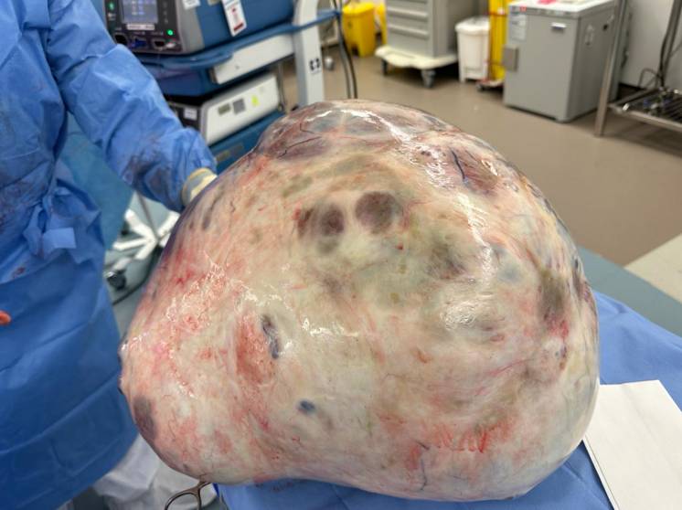 Look: More than 30kg tumour removed from Filipina patient's ovary in UAE